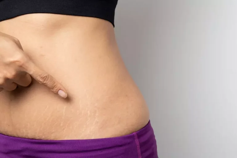 How to Eliminate Stretch Marks: 4 Most Effective Natural Remedies